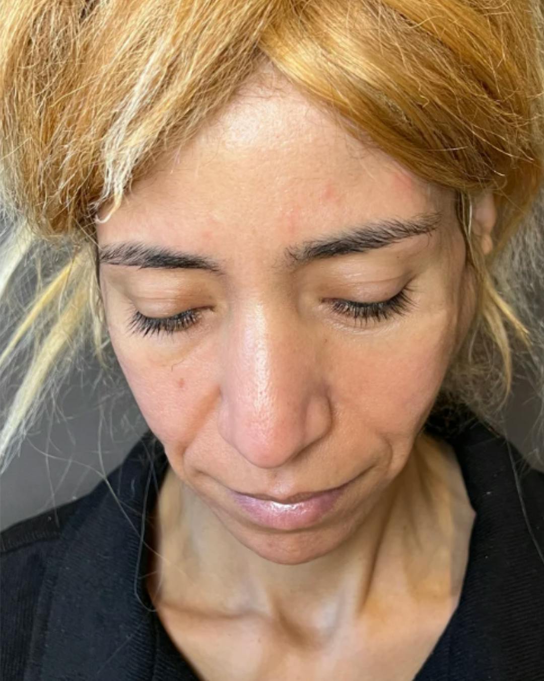 Rhinoplasty Before & After Gallery - Patient 288614 - Image 13