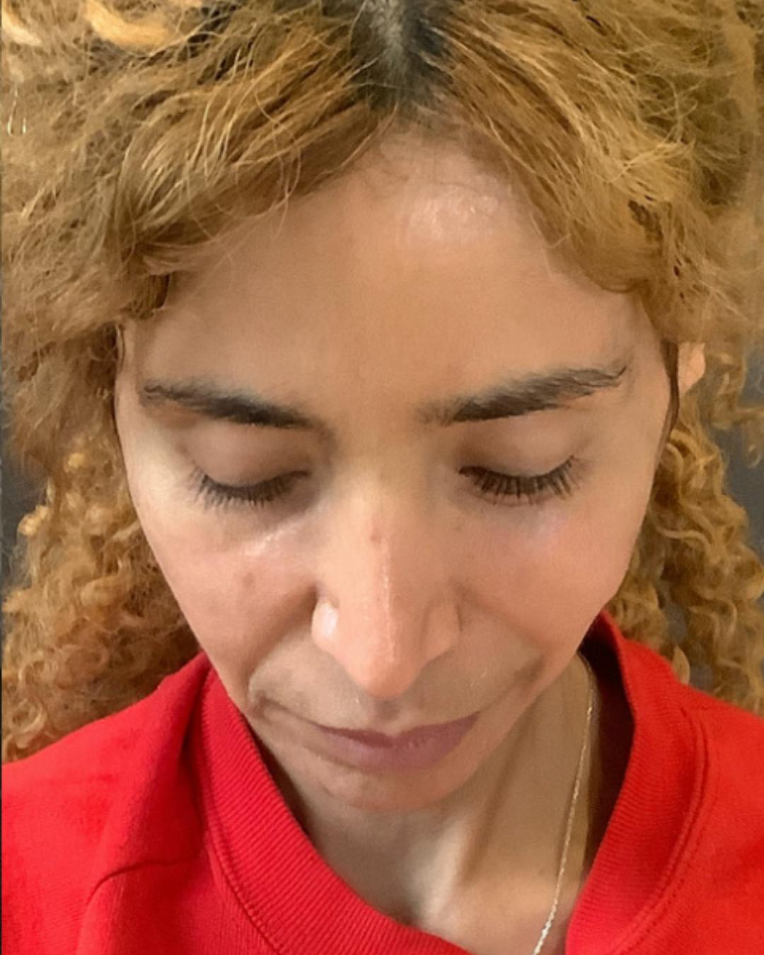 Rhinoplasty Before & After Gallery - Patient 288614 - Image 14