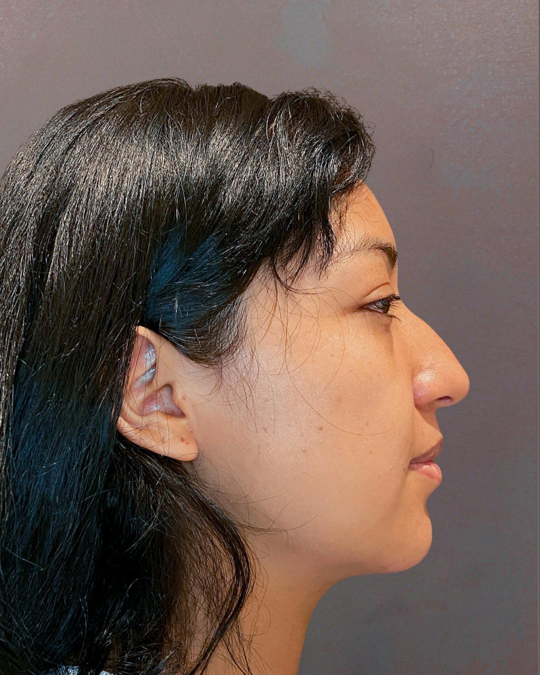 Rhinoplasty Before & After Gallery - Patient 151510782 - Image 1