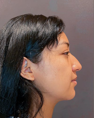 Rhinoplasty Before & After Gallery - Patient 151510782 - Image 1