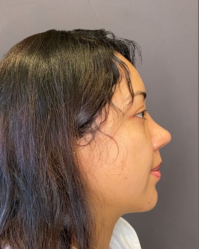 Rhinoplasty Before & After Gallery - Patient 151510782 - Image 2