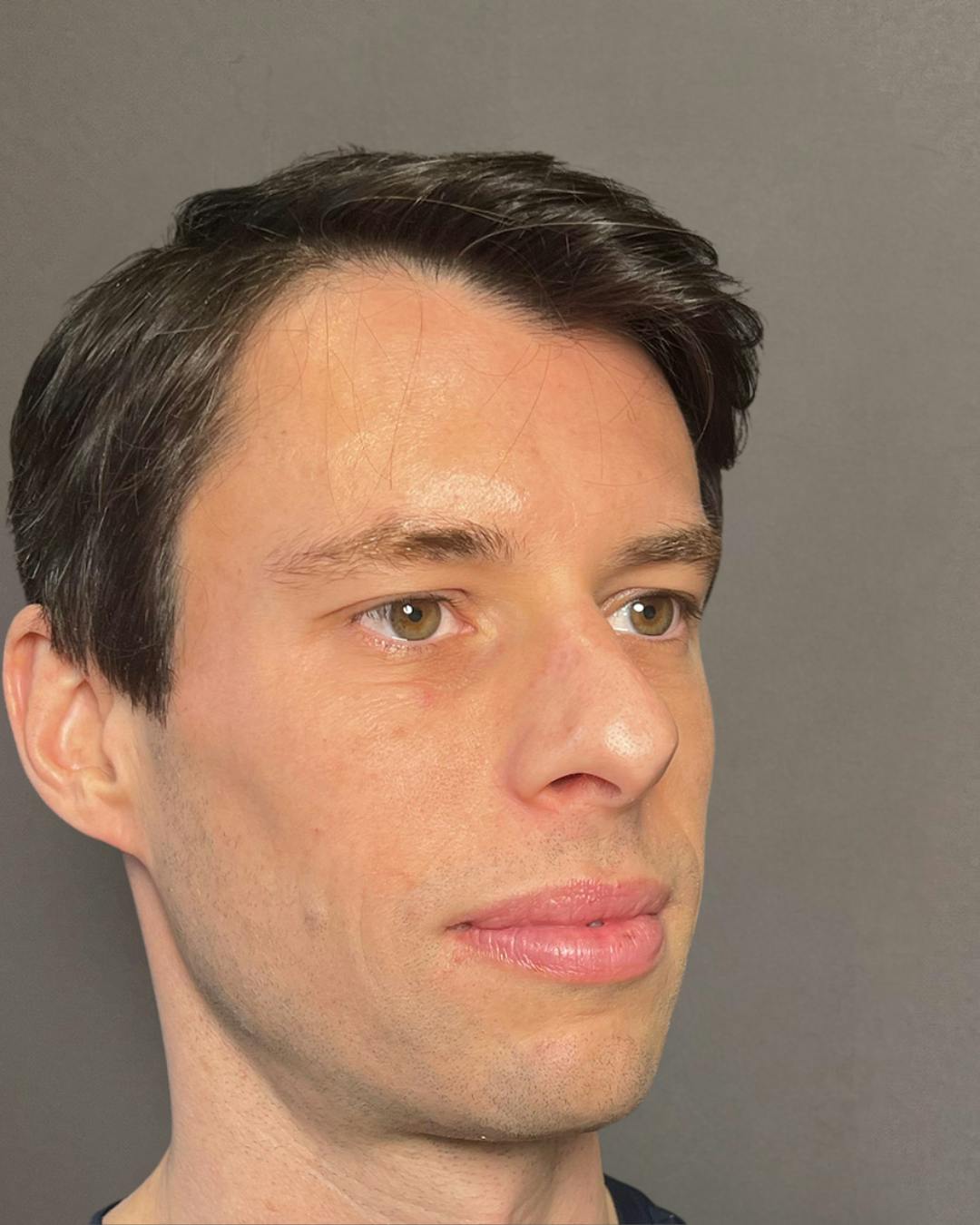 Rhinoplasty Before & After Gallery - Patient 518713 - Image 3