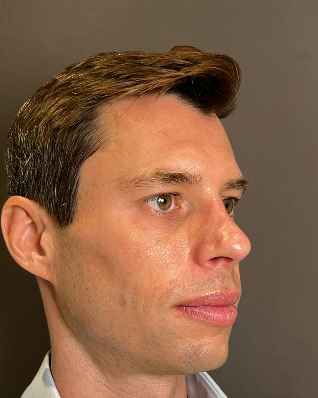 Rhinoplasty Before & After Gallery - Patient 518713 - Image 4