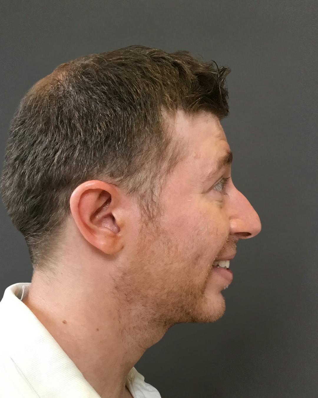 Rhinoplasty Before & After Gallery - Patient 208868 - Image 1