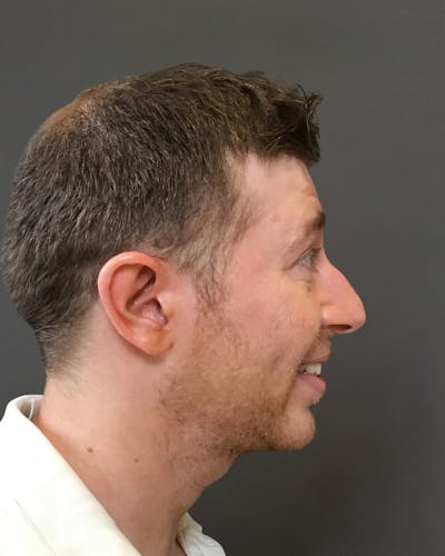 Rhinoplasty Before & After Gallery - Patient 208868 - Image 1