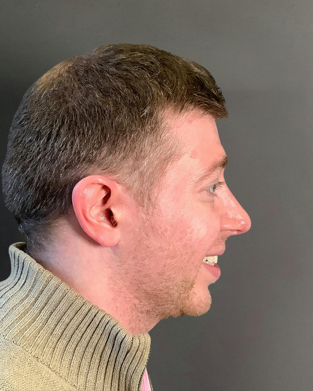 Rhinoplasty Before & After Gallery - Patient 208868 - Image 2