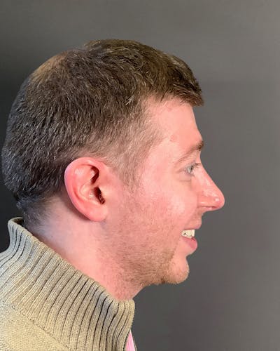 Rhinoplasty Before & After Gallery - Patient 208868 - Image 2