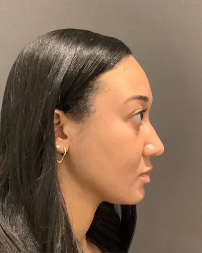 Rhinoplasty Before & After Gallery - Patient 299150 - Image 1