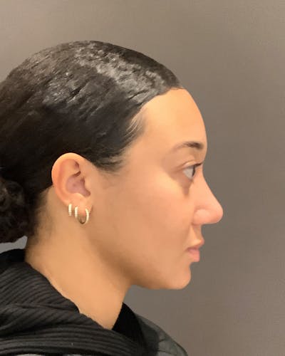 Rhinoplasty Before & After Gallery - Patient 299150 - Image 2