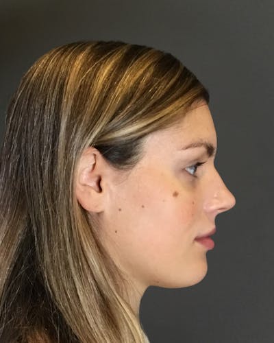 Rhinoplasty Before & After Gallery - Patient 360965 - Image 1