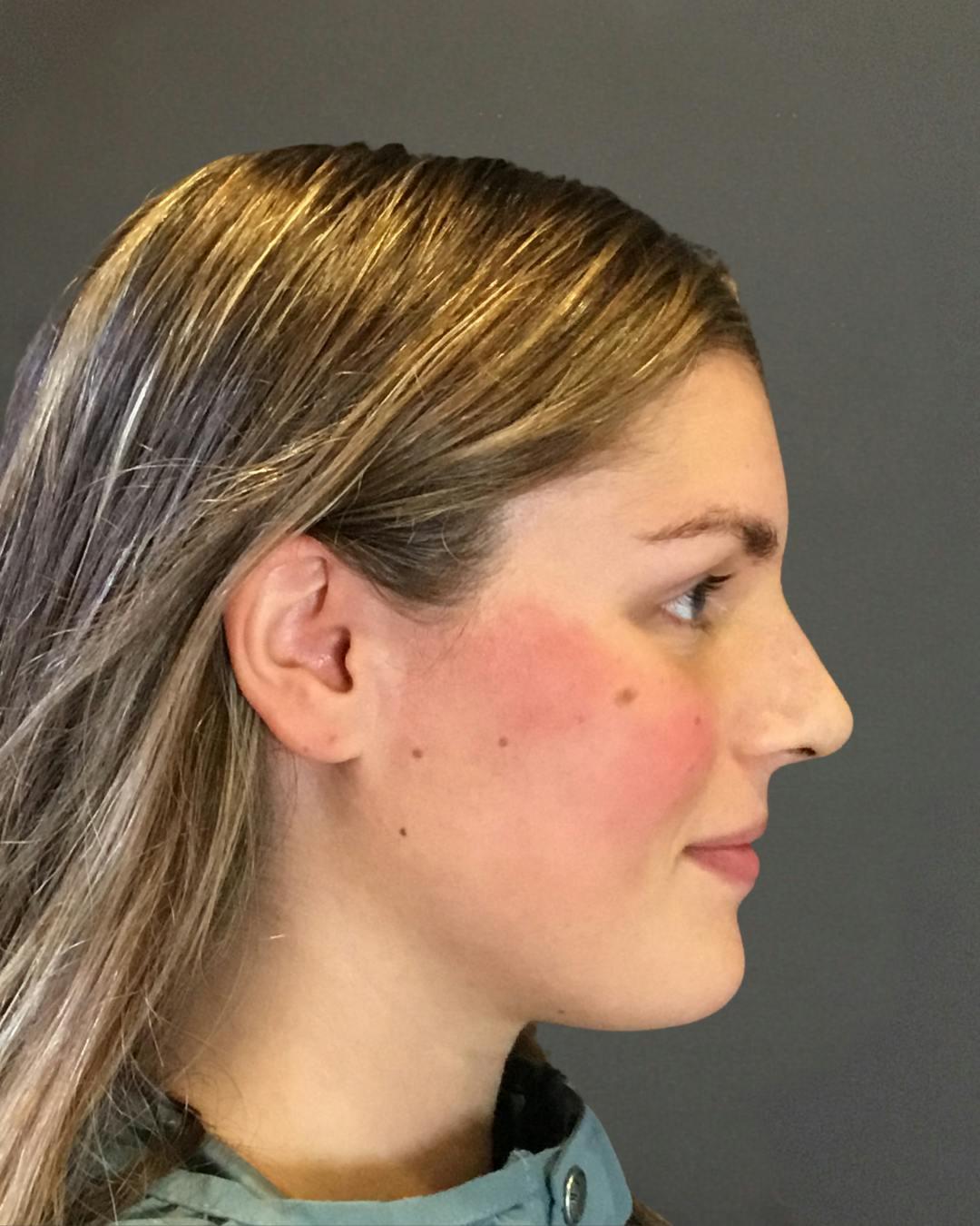 Rhinoplasty Before & After Gallery - Patient 360965 - Image 2