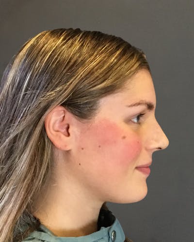 Rhinoplasty Before & After Gallery - Patient 360965 - Image 2