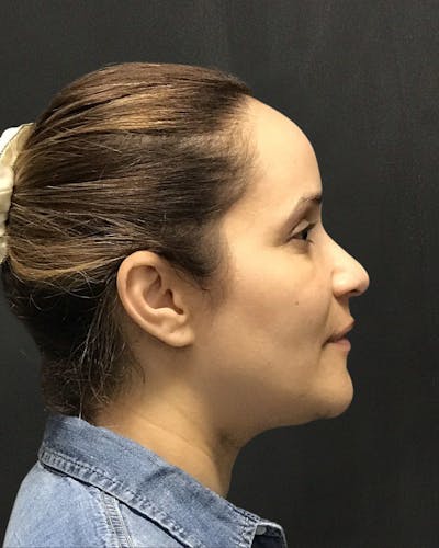 Rhinoplasty Before & After Gallery - Patient 151510788 - Image 1