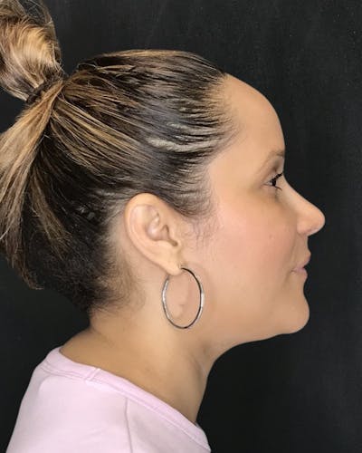 Rhinoplasty Before & After Gallery - Patient 151510788 - Image 2