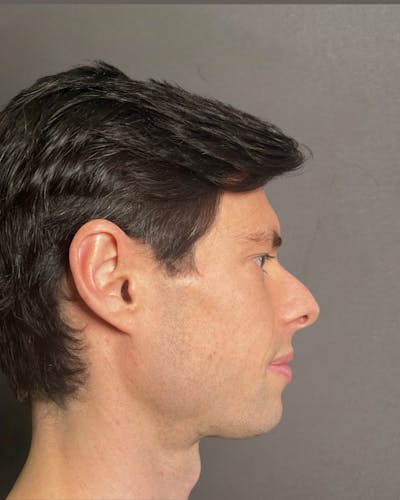 Rhinoplasty Before & After Gallery - Patient 518713 - Image 1