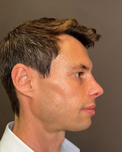Rhinoplasty Before & After Gallery - Patient 518713 - Image 2