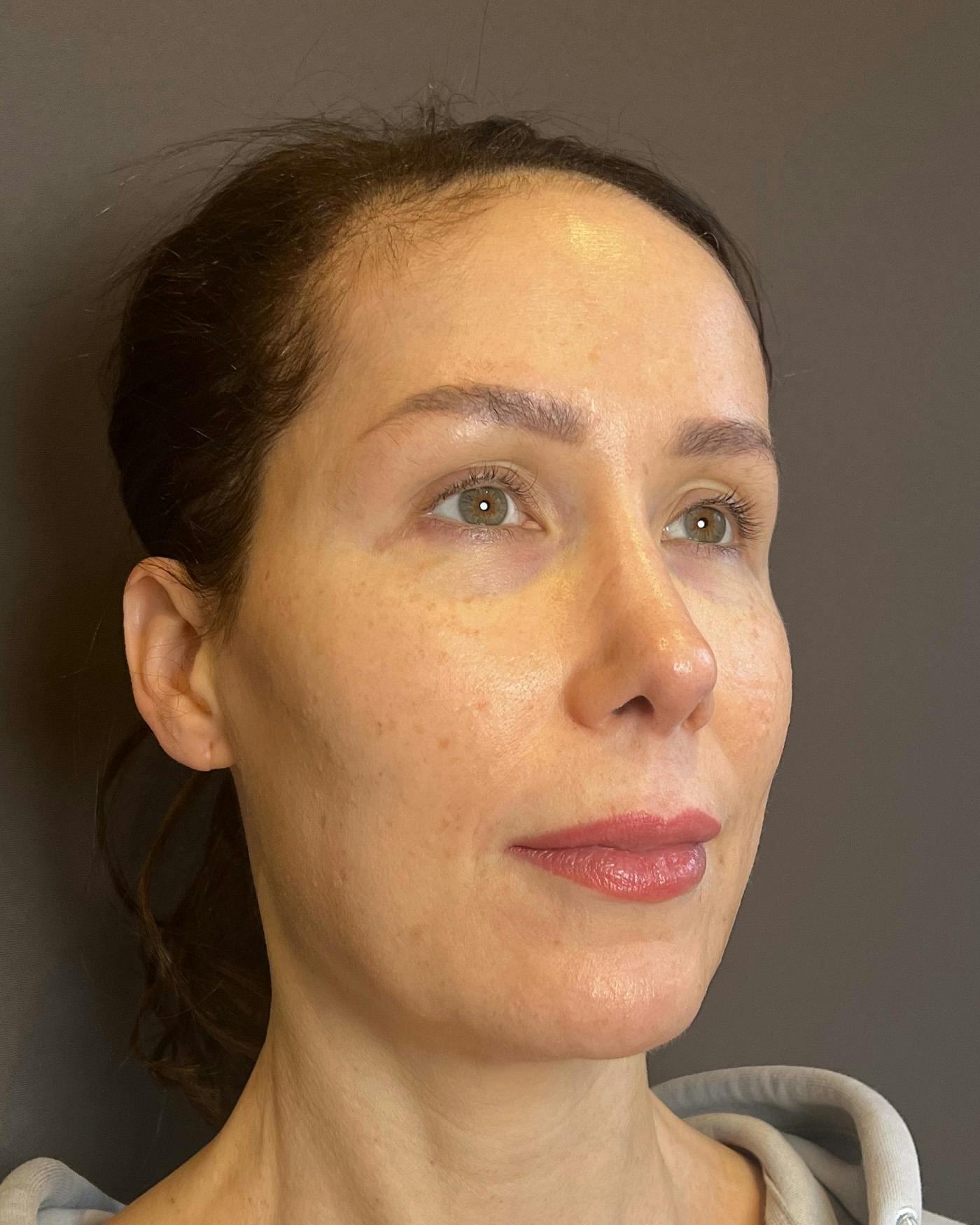 Facelifts / Necklift Before & After Gallery - Patient 159877 - Image 1