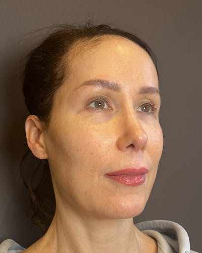 Facelifts / Necklift Before & After Gallery - Patient 159877 - Image 1