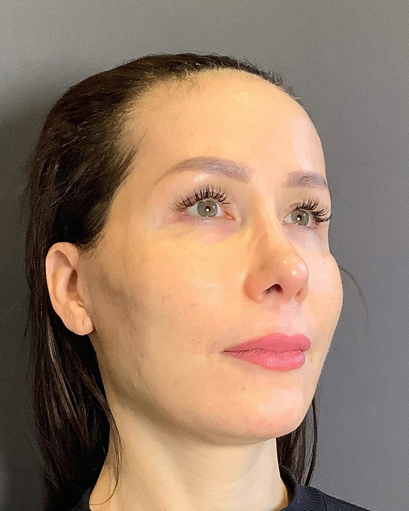Facelifts / Necklift Before & After Gallery - Patient 159877 - Image 2