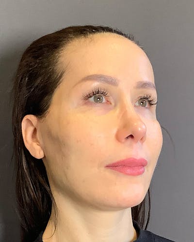 Facelifts / Necklift Before & After Gallery - Patient 159877 - Image 2