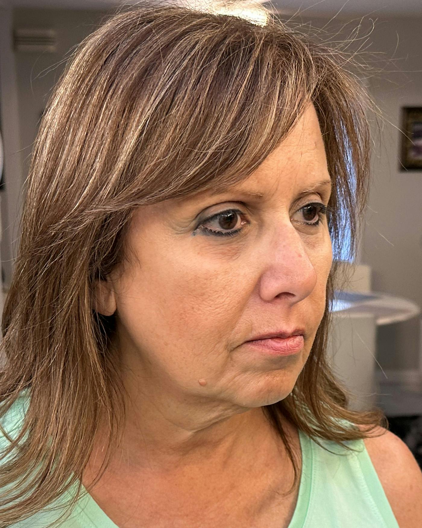 Facelifts / Necklift Before & After Gallery - Patient 249171 - Image 1