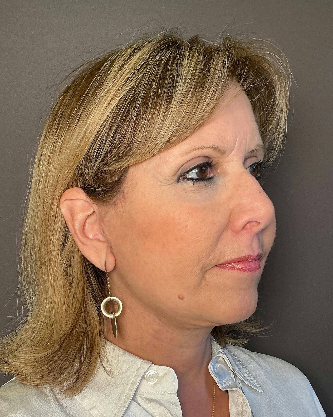 Facelifts / Necklift Before & After Gallery - Patient 249171 - Image 2