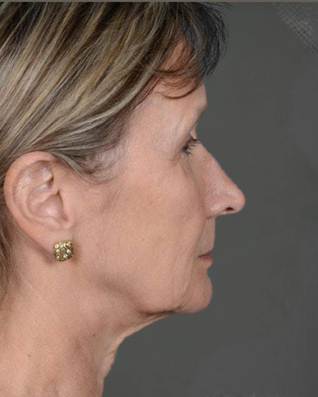 Facelifts / Necklift Before & After Gallery - Patient 151452110 - Image 1
