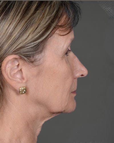 Facelifts / Necklift Before & After Gallery - Patient 151452110 - Image 1