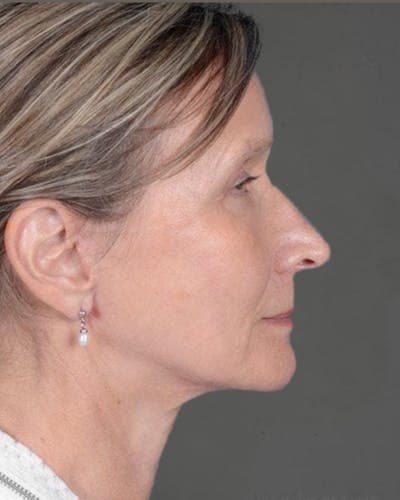 Facelifts / Necklift Before & After Gallery - Patient 151452110 - Image 2