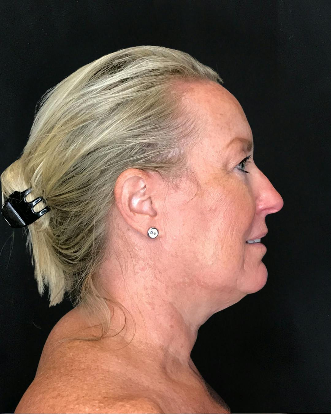 Facelifts / Necklift Before & After Gallery - Patient 286332 - Image 1