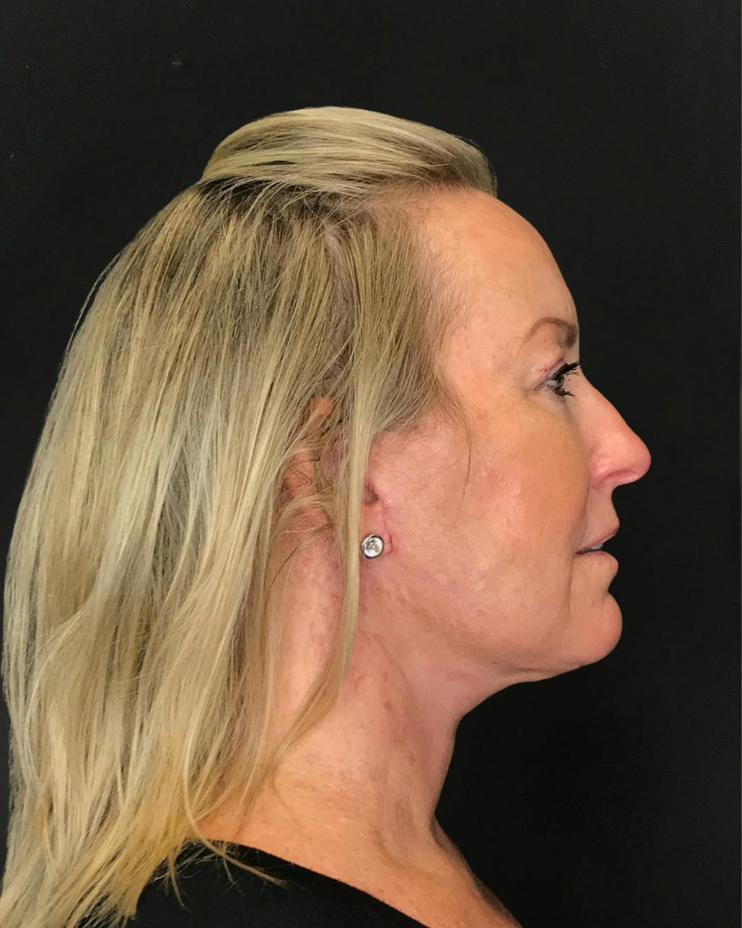 Facelifts / Necklift Before & After Gallery - Patient 286332 - Image 2