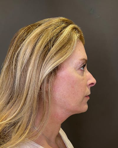 Facelifts / Necklift Before & After Gallery - Patient 830010 - Image 2