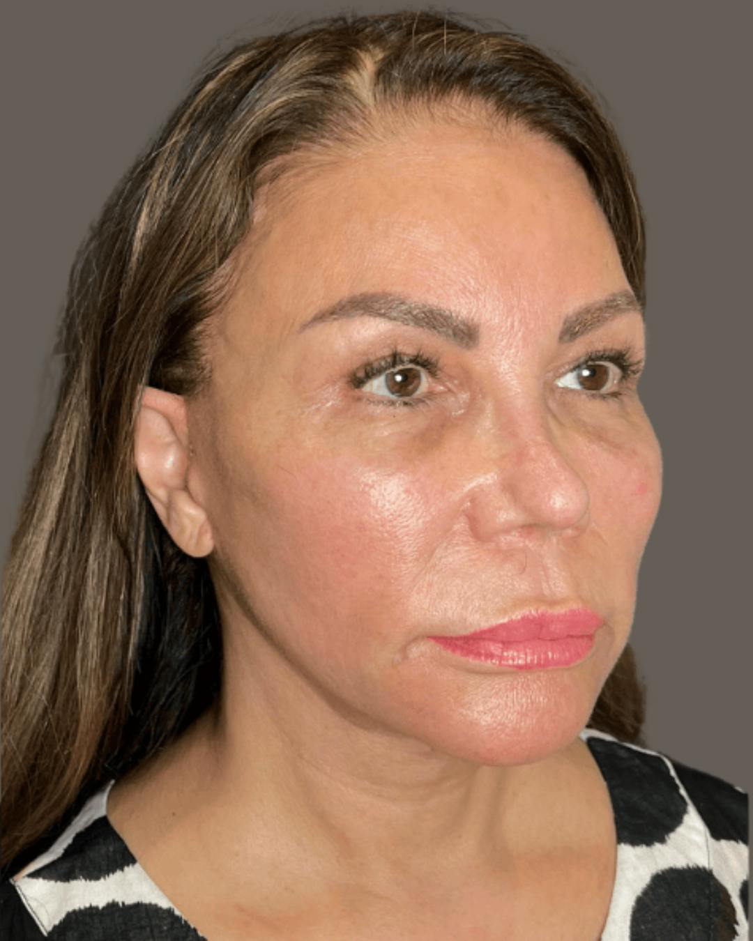 Facelifts / Necklift Before & After Gallery - Patient 359862 - Image 2