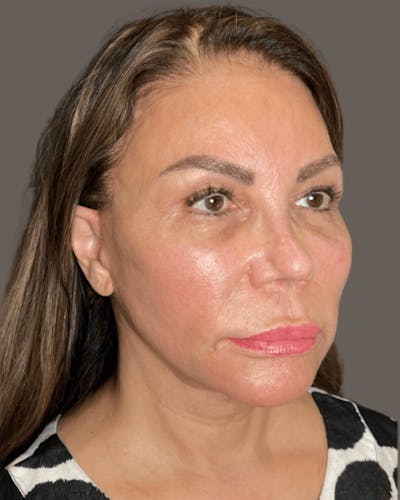 Facelifts / Necklift Before & After Gallery - Patient 359862 - Image 2