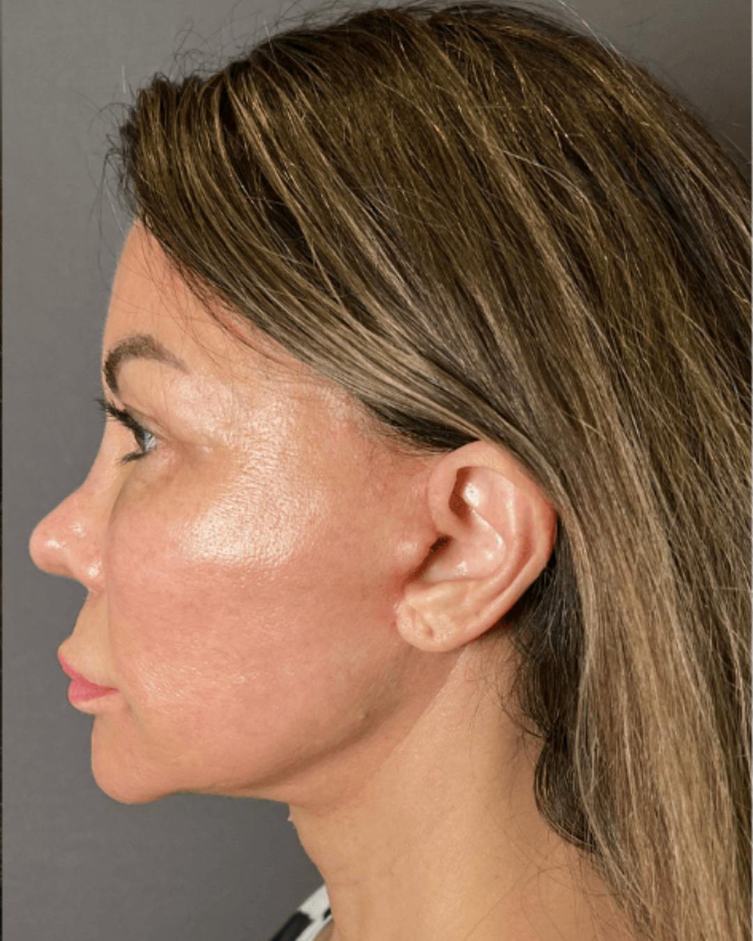 Facelifts / Necklift Before & After Gallery - Patient 359862 - Image 8
