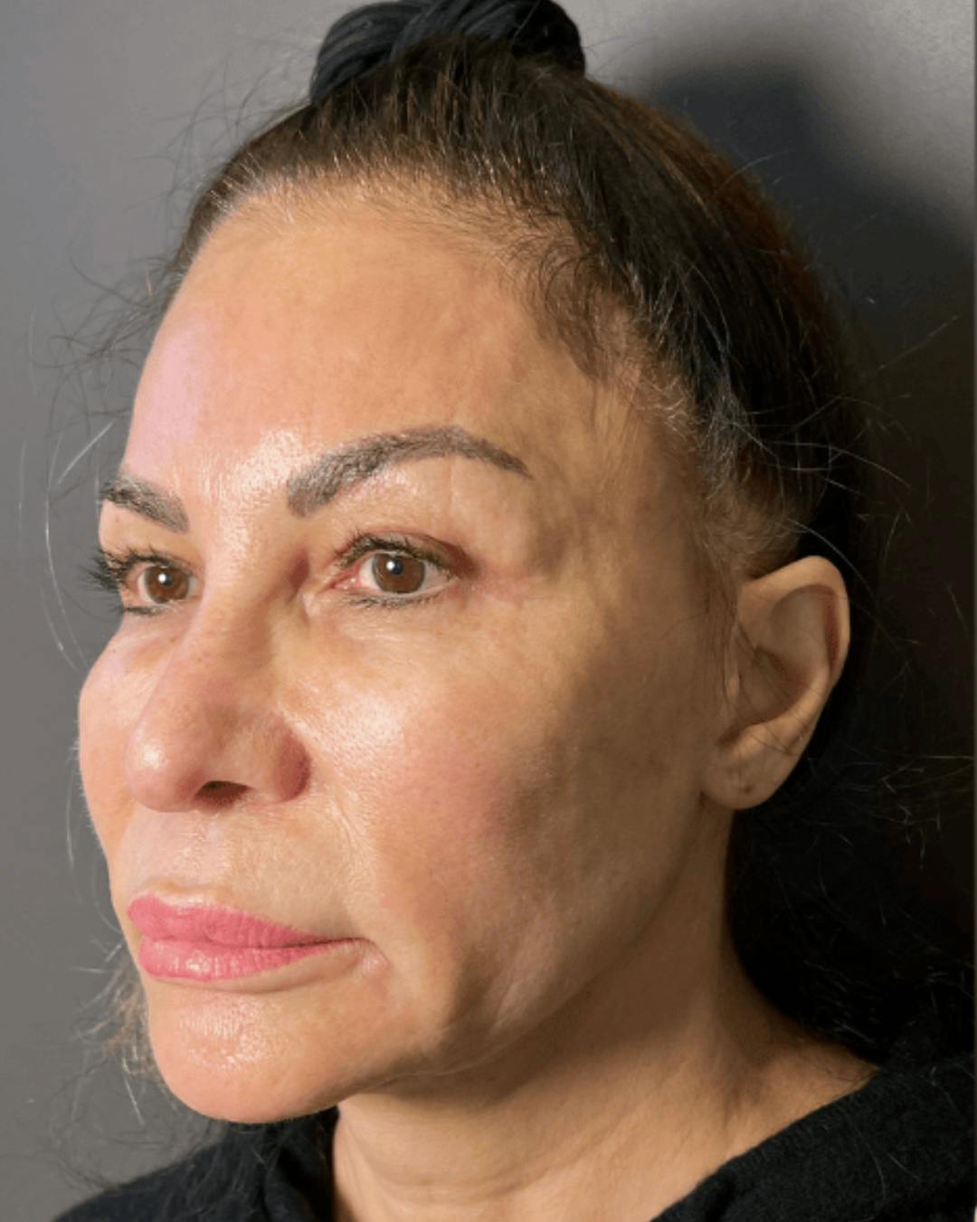 Facelifts / Necklift Before & After Gallery - Patient 359862 - Image 5