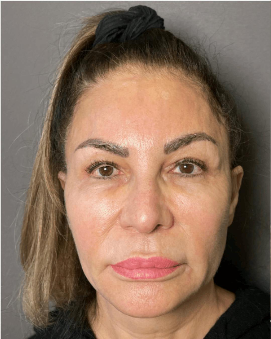 Facelifts / Necklift Before & After Gallery - Patient 359862 - Image 3