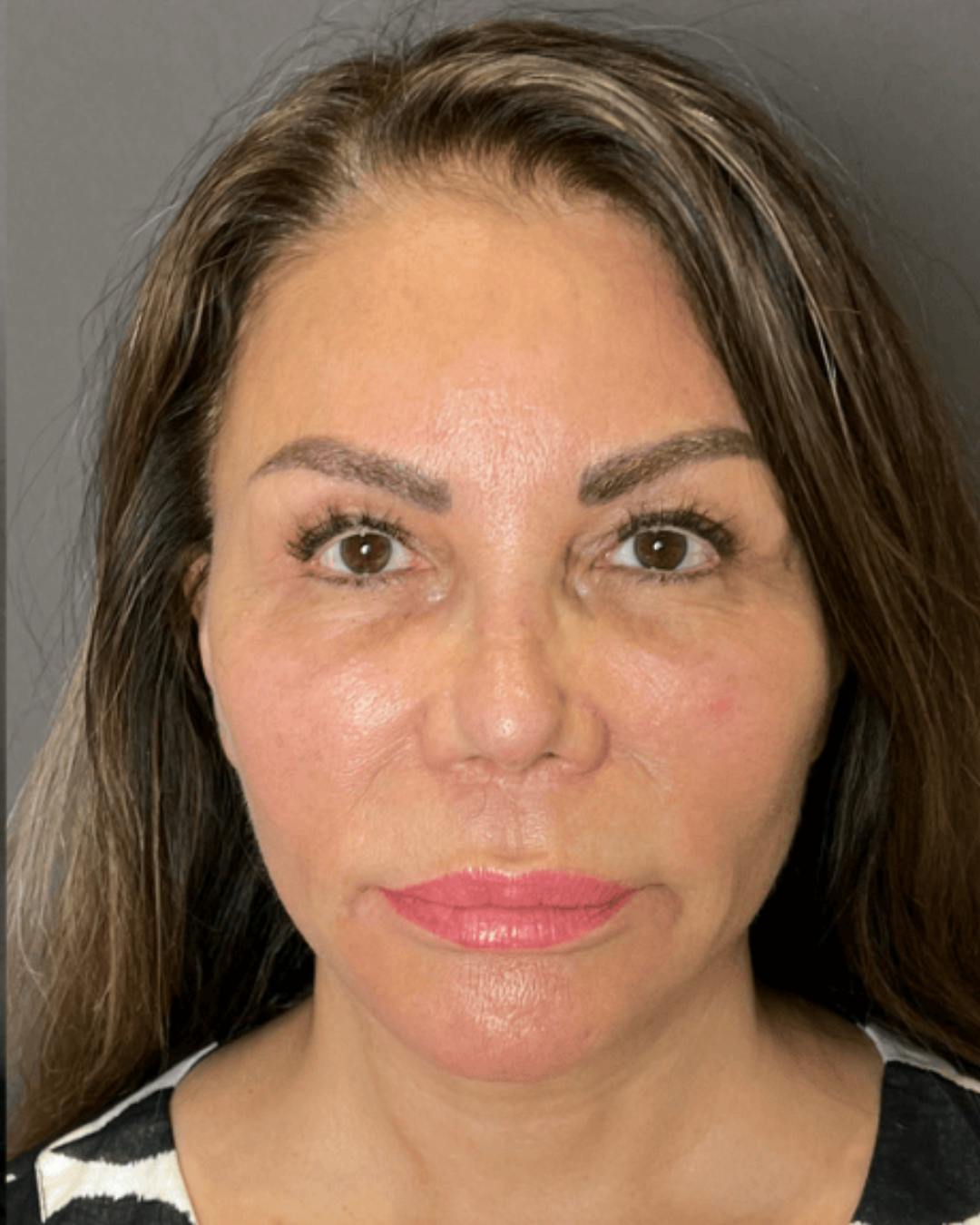 Facelifts / Necklift Before & After Gallery - Patient 359862 - Image 4