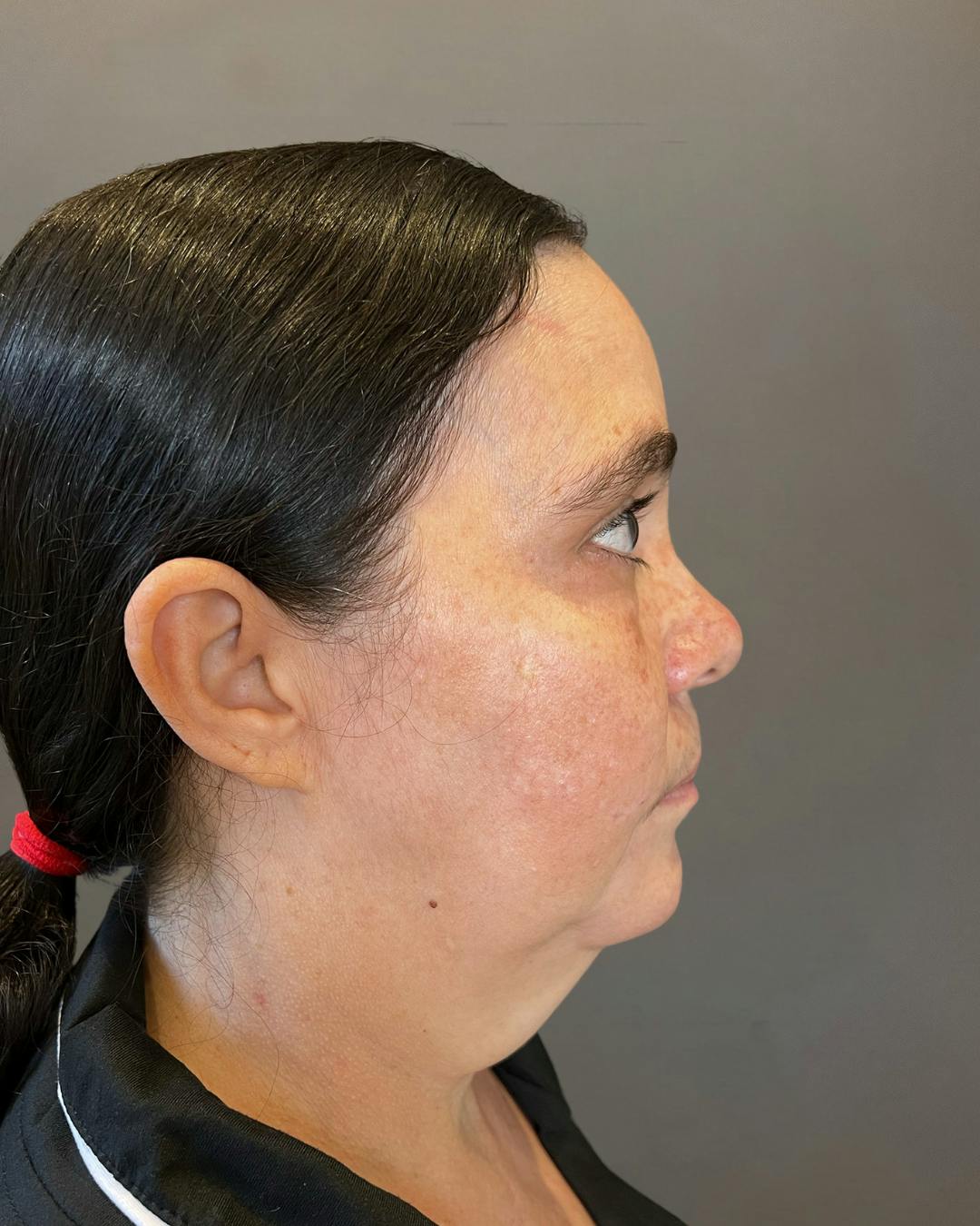 Facelifts / Necklift Before & After Gallery - Patient 754198 - Image 1