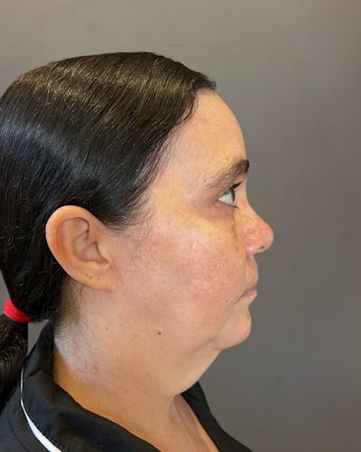 Facelifts / Necklift Before & After Gallery - Patient 754198 - Image 1