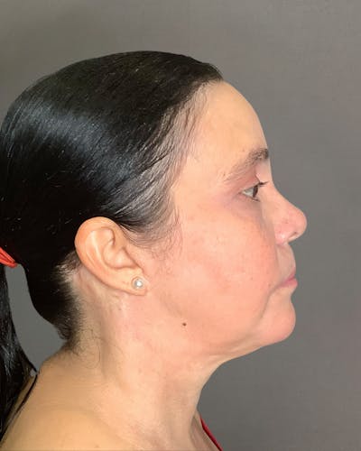 Facelifts / Necklift Before & After Gallery - Patient 754198 - Image 2