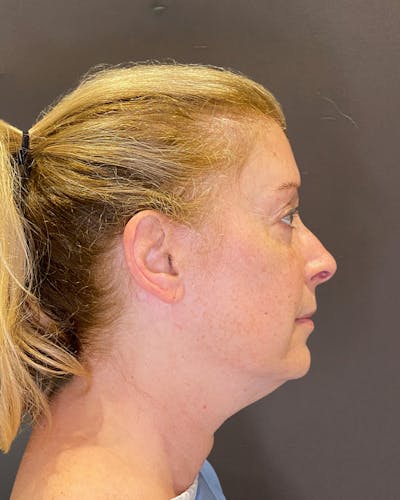 Facelifts / Necklift Before & After Gallery - Patient 830010 - Image 1