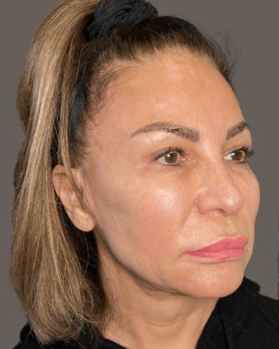 Facelifts / Necklift Before & After Gallery - Patient 359862 - Image 1