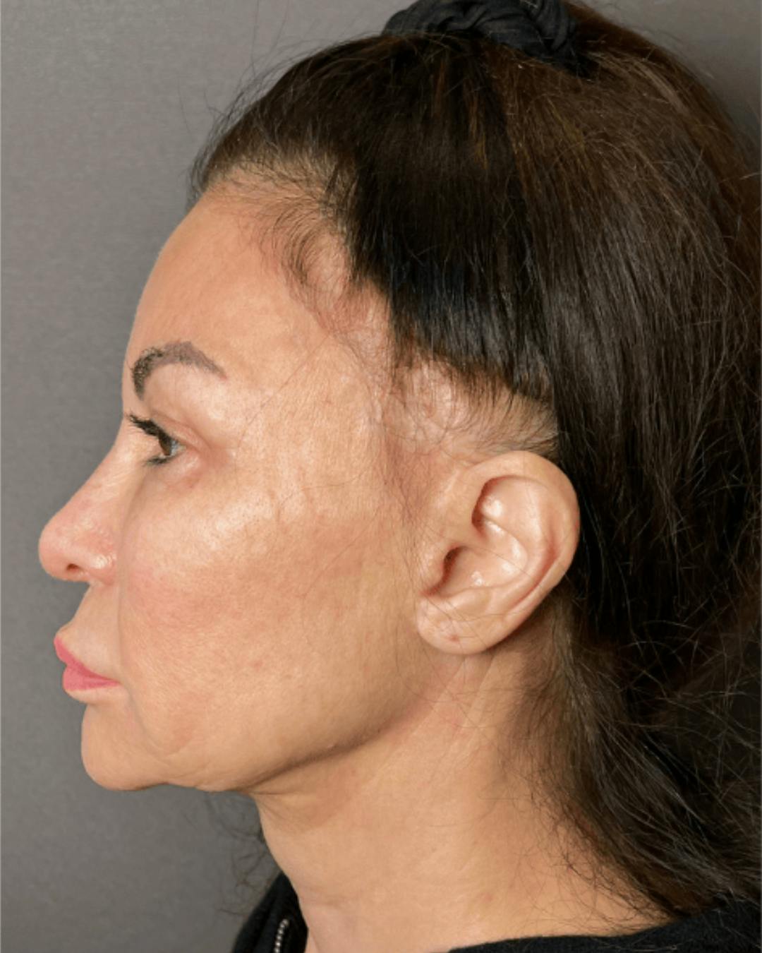 Facelifts / Necklift Before & After Gallery - Patient 359862 - Image 7
