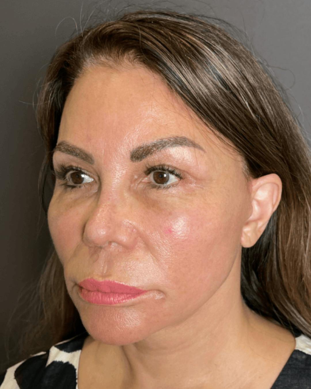Facelifts / Necklift Before & After Gallery - Patient 359862 - Image 6