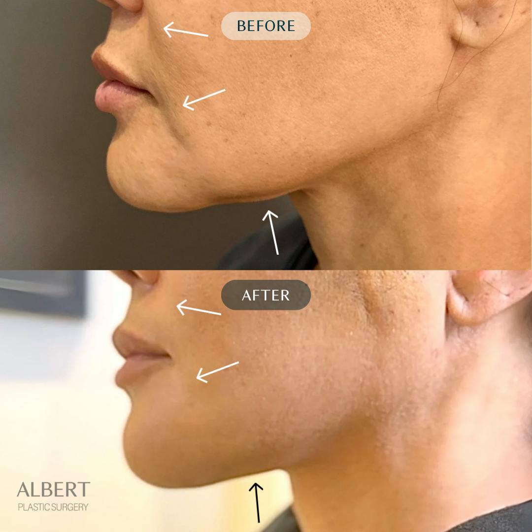 Nanolift Before & After Gallery - Patient 142439 - Image 3