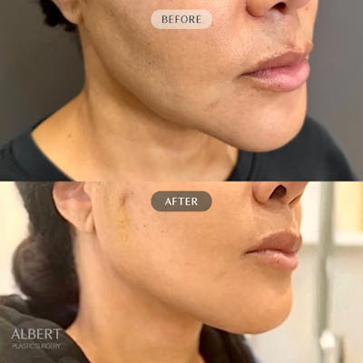 Nanolift Before & After Gallery - Patient 142439 - Image 1