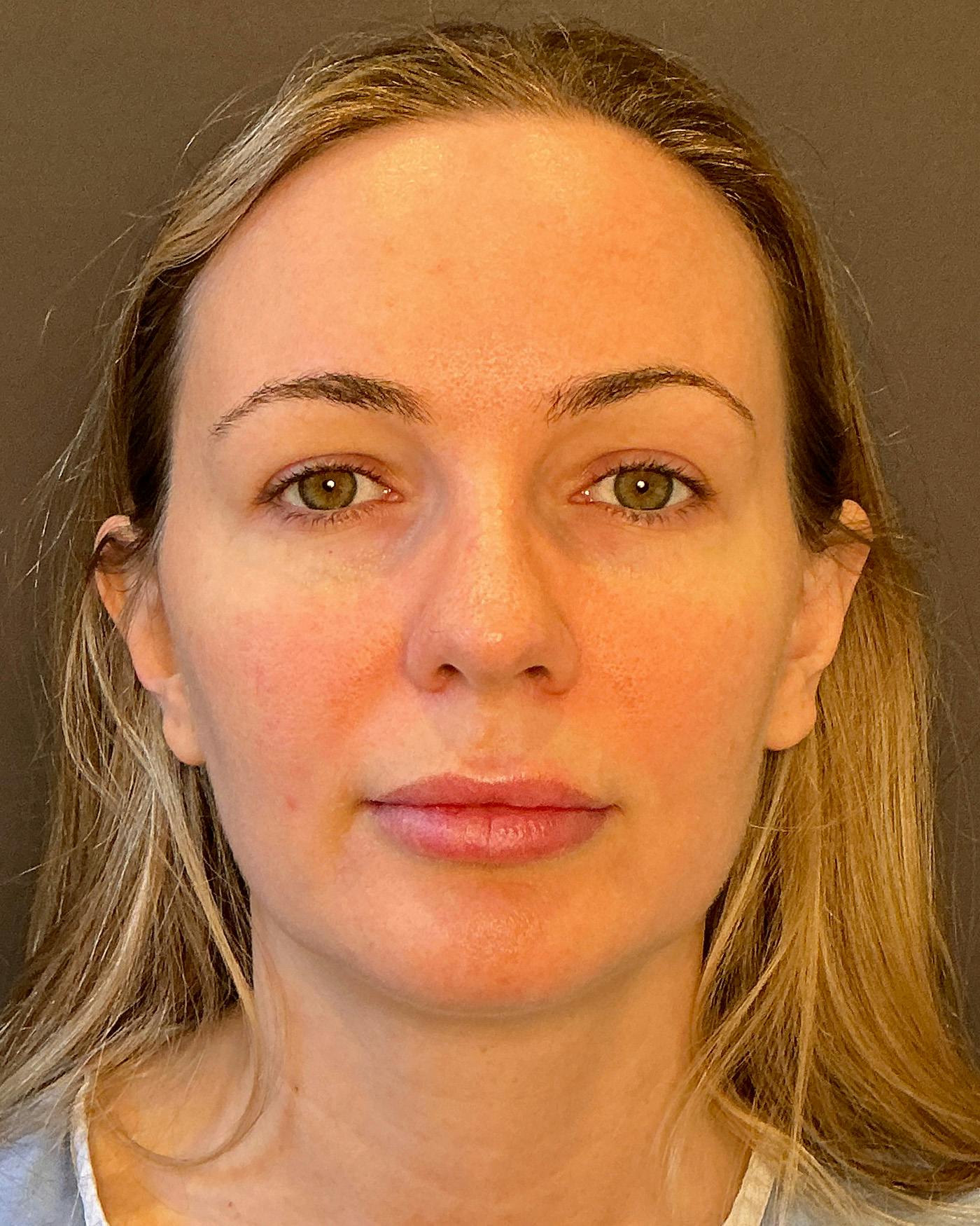 Nanolift Before & After Gallery - Patient 215709 - Image 1