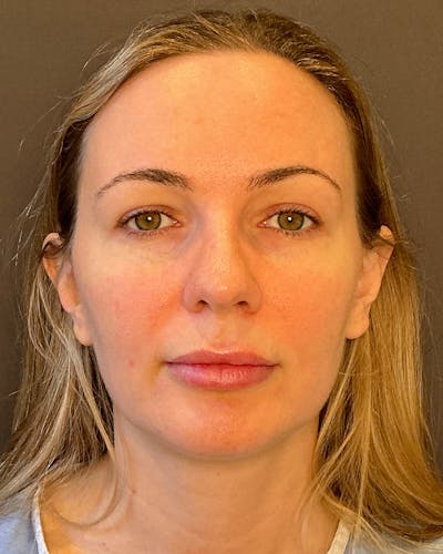 Nanolift Before & After Gallery - Patient 215709 - Image 1