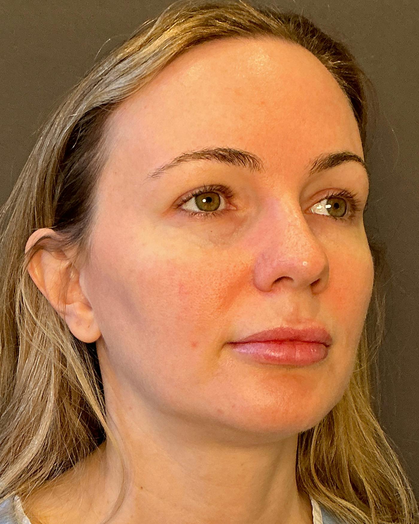Nanolift Before & After Gallery - Patient 215709 - Image 3